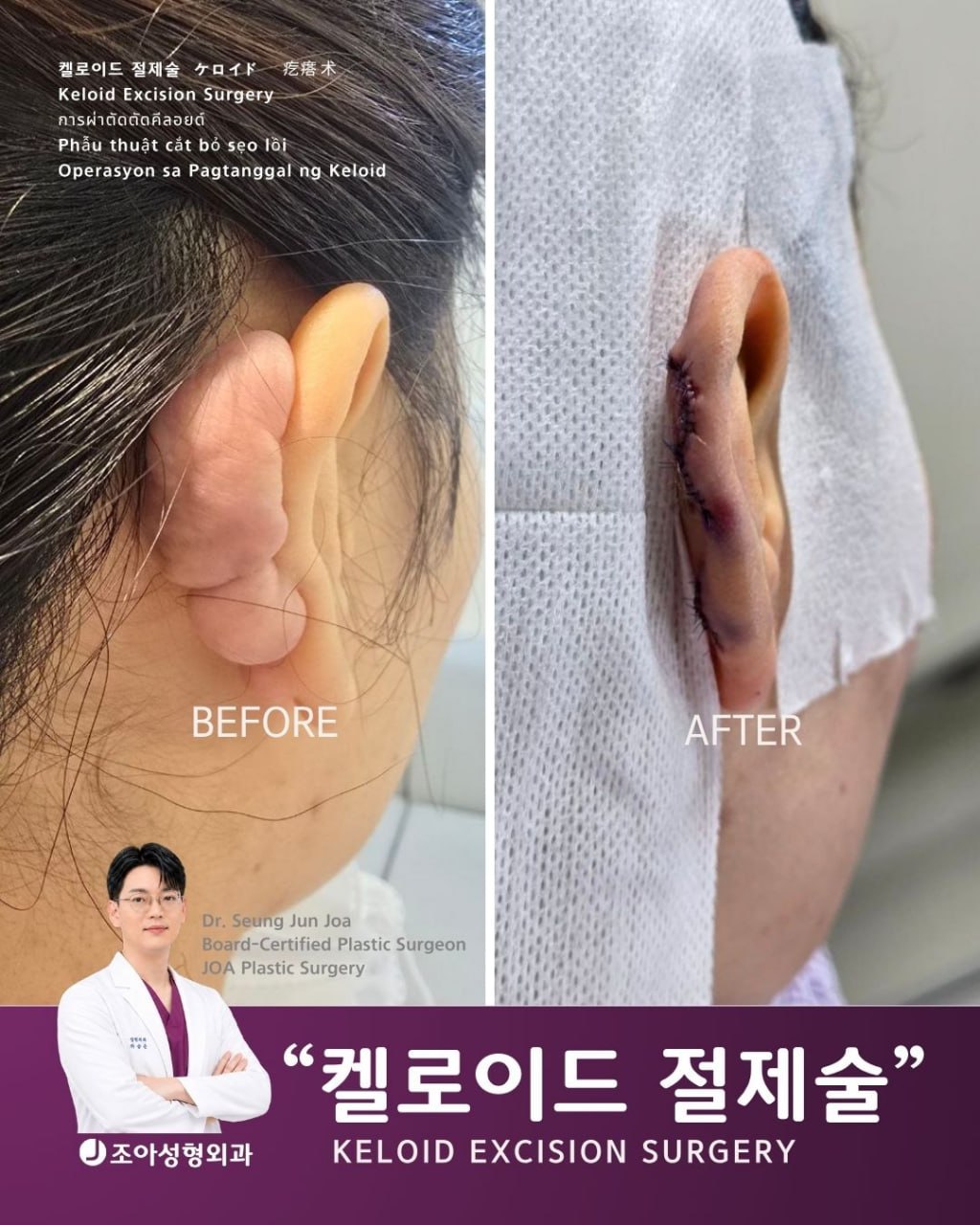 귀에 하나 생기는 켈로이드부터 몸 곳곳에 발생하는 다발성 켈로이드까지