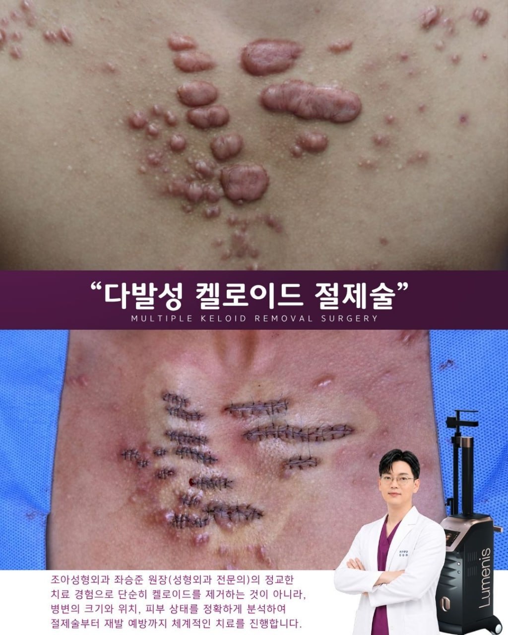 다발성 켈로이드, 모두 잘라내는 것이 답은 아니다